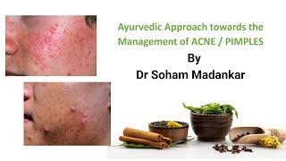 Ayurvedic  Approach towards the management of ACNE / pimples