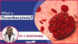 Thrombocytosis : High Platelet Count Symptoms, Conditions & Treatment Procedures | TimesXP
