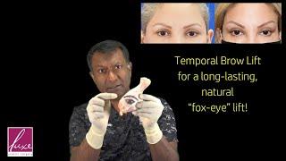 "Fox-Eye" Brow Lift using a minor procedure for long-lasting, natural results. Temporal Brow Lift