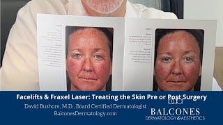 Facelifts & Fraxel-Treating the Skin for Optimal Results | David Bushore, M.D.| Ph: 512-459-4869