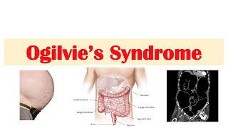 Ogilvie Syndrome | Pseudo-Obstruction of the Large Intestine: Causes, Symptoms, Diagnosis, Treatment