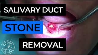 Salivary Duct Stone - Sialolithiasis - How to Treat?