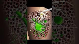 ASMR Treatment Animation of Spider and Maggot Removal in Belly Button