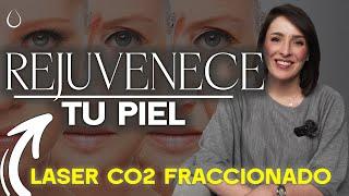 FRACTIONAL CO2 LASER @drapilarochoa - Dermatologist