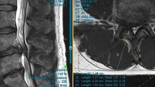 Case Review Series: Stenosis and Disc Herniation