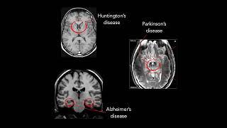 Genetics and Pathogenesis of Amyotrophic Lateral Sclerosis & Frontotemporal Dementia