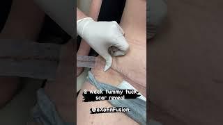 2 week tummy tuck scar reveal