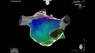 Flutter atriale sinistro, in re-do post ablazione di fibrillazione atriale #electrophysiology