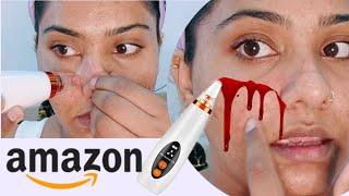 OMG I TRIED THIS BLACKHEAD REMOVAL DEVICE FROM AMAZON/EXPERIMENT WITH SKIN/