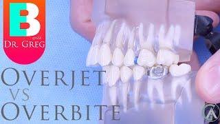 [BRACES EXPLAINED] Overbite vs Overjet