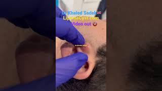 Massive blackhead extraction #skincare #blackheadremoval Dr Khaled Sadek