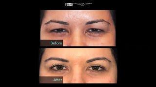 Best Eyelid Surgery in Houston - Dr. Charles Soparkar