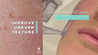 Fractional CO2 Laser Singapore - FAQ | Acne Scars Treatment