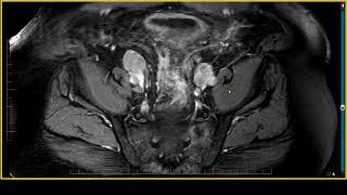 PI RADS 5 Case Review on MRI