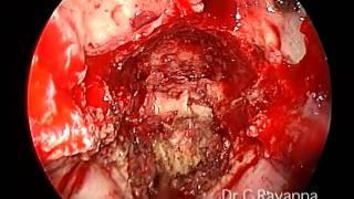 Endoscopic transnasal odontoidectomy by Dr. C. Rayappa