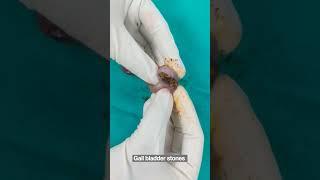 #Gallbladder stones #shorts पित्त की पथरी #healthmedia