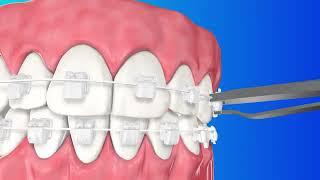 3M Clarity Ultra- Bracket Closing Demo | pinkblue