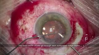 Scleral-sutured IOL with Prolene Suture | Dr Sami A. Saad feat Dr A. Oulmidi