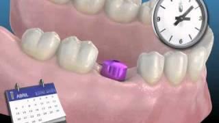 Los implantes dentales