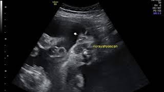 baby girl peed in womb by norayahyascan