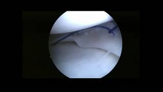 Outside-In Single–Lasso Loop Technique for Meniscal Repair: Fast, Economic, and Reproducible