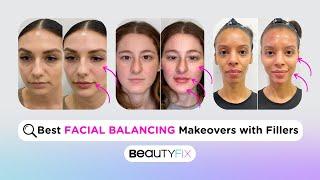 BeautyFix MedSpa's BEST Full Facial Filler Transformations! | BeautyFix