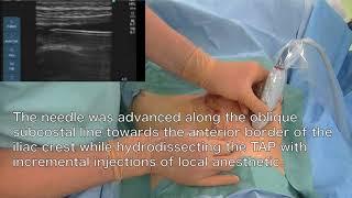 Practical tips for placement of TAP catheter