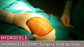 Bilateral Hydrocelectomy Surgery Step by Step - Cuneyd Sevinc, MD