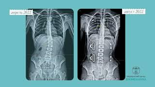 Безоперационное лечение сколиоза 2й степени, Владивосток.