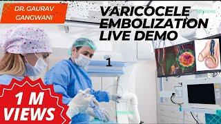 Live Varicocele Embolization Case 1| Non-surgical treatment of Varicocele | Dr. Gaurav Gangwani