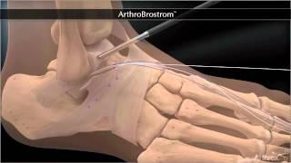 Bandrekonstruktion bei chronischer Instabilität des Sprunggelenkes - Arthroscopic Broström