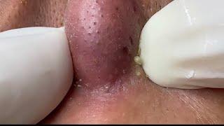 The most satisfying video for nose black and whiteheads removal #blackheads #acne #foryou #squeeze