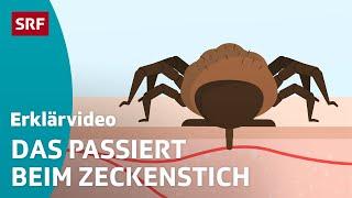 Zeckenstich & übertragbare Krankheiten – einfach erklärt | Kindervideos | SRF Kids