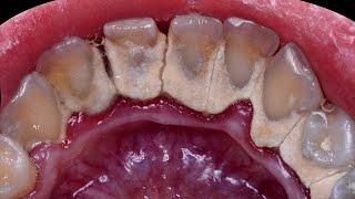 21 yo. Female's Teeth | Tartar Removal | Scaling | Dentist | Dokter Gigi Tri Putra