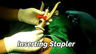 Stapler Circumcision Surgery, Procedure, Advance Technique, Penis, Nashik, Jabalpur, Surat, Gujarat