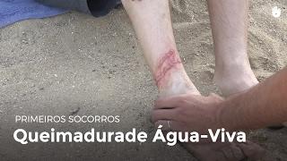 Queimadura de Água-Viva | Primeiros socorros