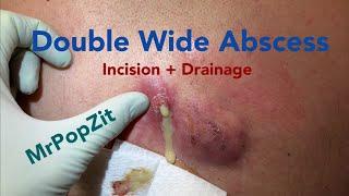 The double wide, double pop, giant abscess. Multiple pockets and sinus tracts expressed and cleared.