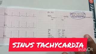 Sinus Tachycardia I #ECG रिपोर्ट कैसे देखते हैं।