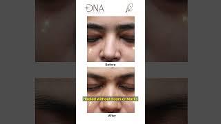 Xanthelasma laser Before and After | By Dermatologist ‍| Dr. Priyanka Reddy | DNA Skin Clinic |