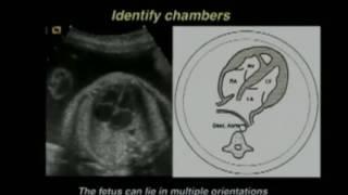 Efficient and Effective Interpretation of the Four Chamber Heart View and Views of the Great Arterie