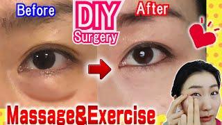 How to Remove Under Eye Bags️ Naturally in 7 Days Massage & Exercises
