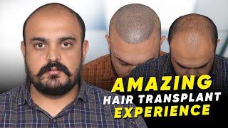 Hair Transplant in Chandigarh | Best Results & Cost of Hair Transplant in Chandigarh