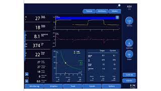 An Overview of Adaptive Support Ventilation (ASV)