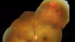 RETINAL CAPILLARY HAEMANGIOMA IN VON HIPPEL-LINDAU SYNDROME