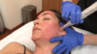 Microneedling with PRP Demo | Beleza MedSpa | Austin, TX