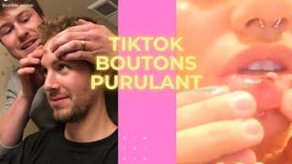 TIKTOK BOUTON PIMPLE POPPING 7