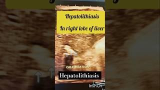 Liver #ultrasound ll hepatolithiasis ultrasoundllhepatic calcification #hepatic #livercirrhosis