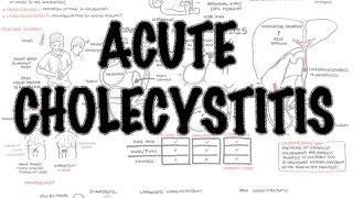 Acute Cholecystitis - Overview (signs and symptoms, pathophysiology, treatment)