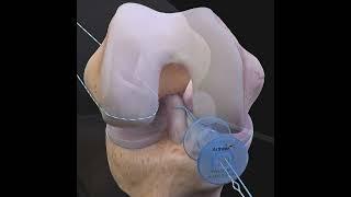 ACLtear.com - Arthrex ACL Repair