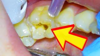 Dentist Shows How to Reverse a Cavity & If It Is Possible That You Can Cure Tooth Decay Naturally!